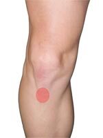 runners knee  treatments